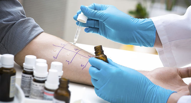 Pruebas de alergia